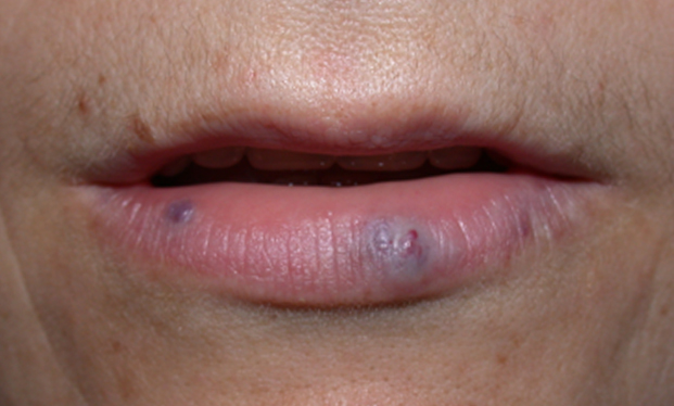 Telangiectasia Hemangiomas Doctor V