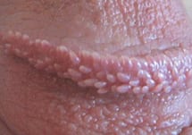 Penis tiny bumps head around Rough Patch/Bumps