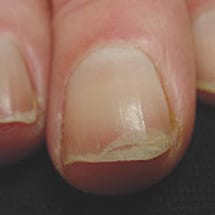 Onychoschizzia (Brittle Nails, Damaged Nails, Peeling Nails) – Doctor V.